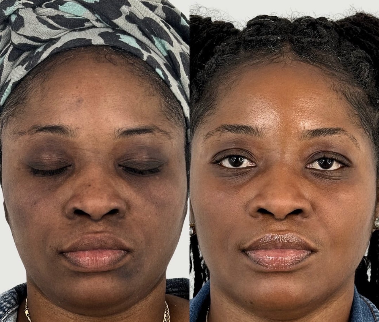 Deep skin tone · uneven pigment