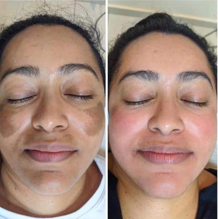 Post-inflammatory pigment · cheeks